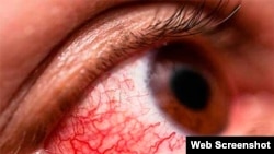 Conjuntivitis Hemorrágia Epidémica